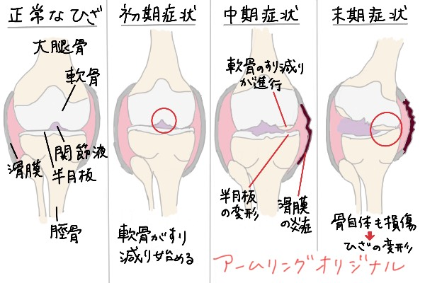 変形性膝関節症の各段階の症状