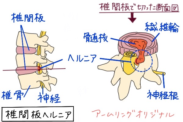 椎間板で切った断面図