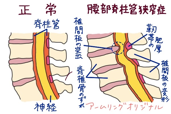 腰部脊柱管狭窄症